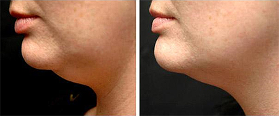 Perfectly You > Strawberry Laser Lipo > Stomach Before & After