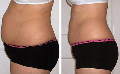 Perfectly You > Strawberry Laser Lipo > Stomach Before & After